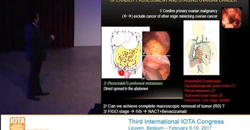 IOTA: Full body MRI to stage ovarian cancer and role of PET CT in recurrent disease