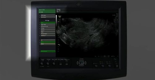 Voluson Performance Series: 3D Gynecology