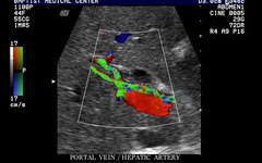 Sonography - Portal Venous Hypertension