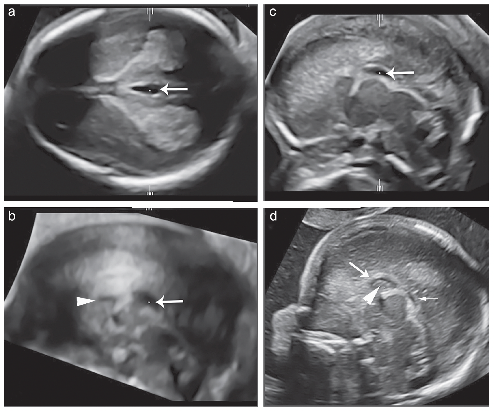 (a–c) Neurosonography at 15 gestational weeks.