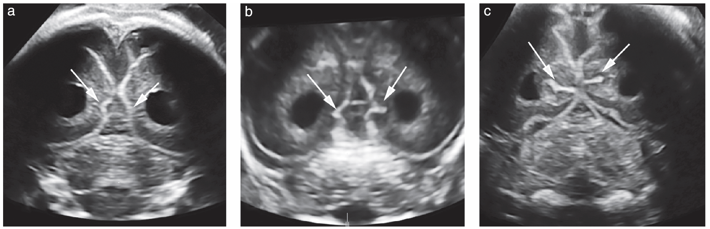 On transcerebellar view of fetal head
