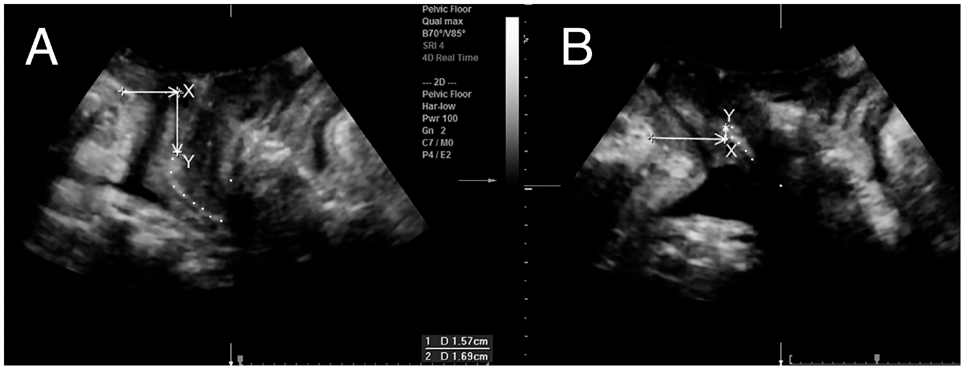 Laparoscopic Sacrocolpopexy mesh at rest (A) and on Valsalva (B).
While such mesh is often too cranial to be clearly visible on translabial ultrasound,
it may be evident under the bladder neck and trigone, similar to vaginally
inserted mesh. Its cranial aspects are often obscured by prolapse of the
posterior compartment, as evident in (B).