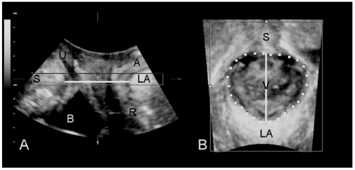 4D acquisition for organ descent and hiatal ballooning