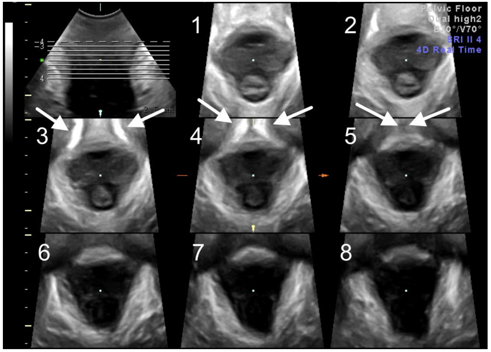 TUI in the C (axial) plane for assessment of levator integrity. Slice 1
is the caudal slice, slice 8 is the most cranial cranial slice.