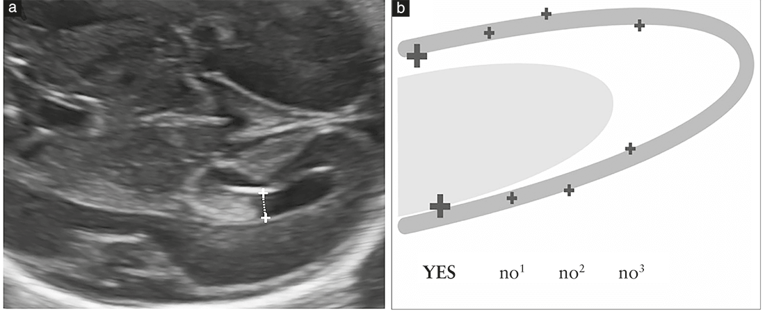 ISUOG Guidelines Figure 5